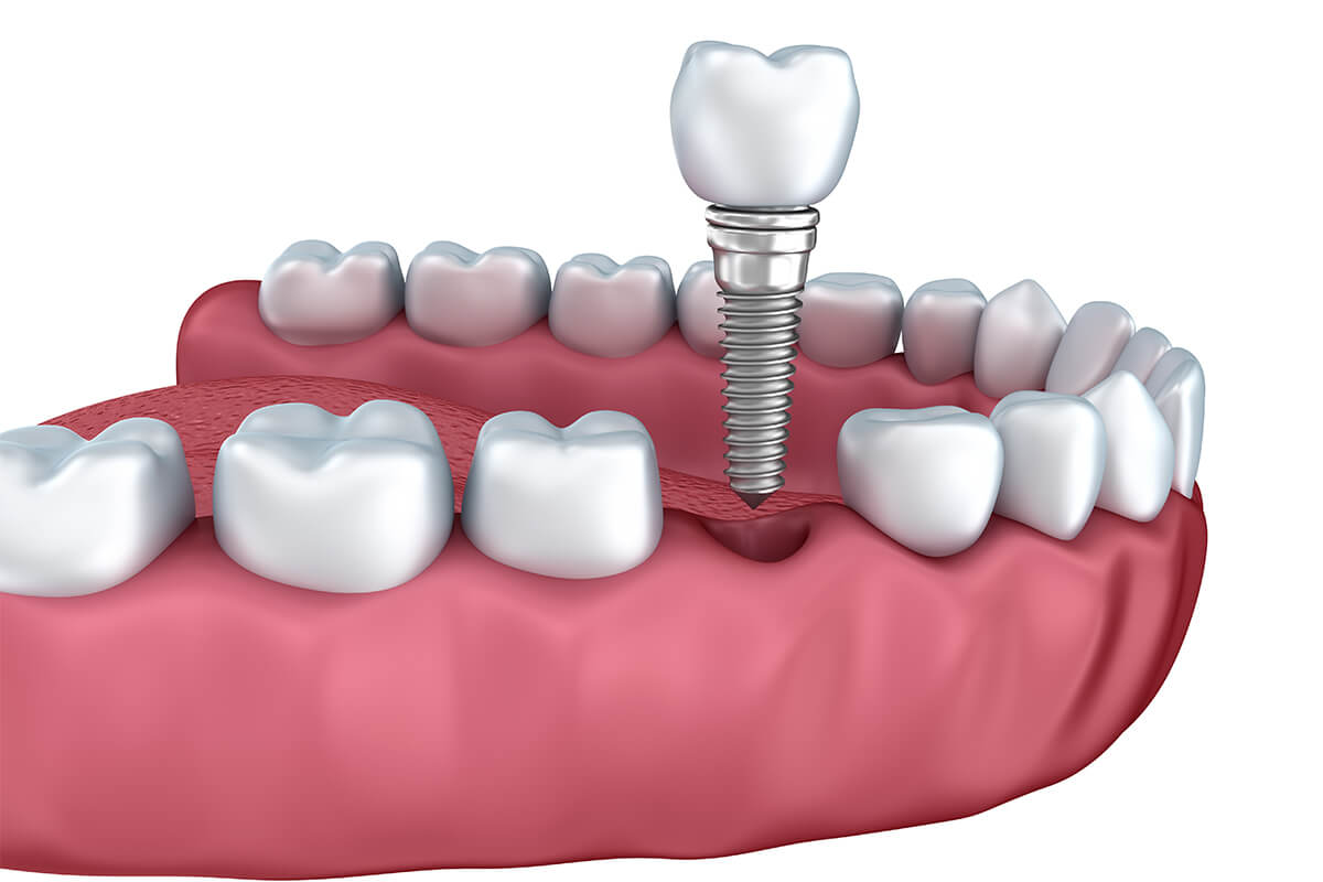 Implants Dentist in Newport Beach CA Area