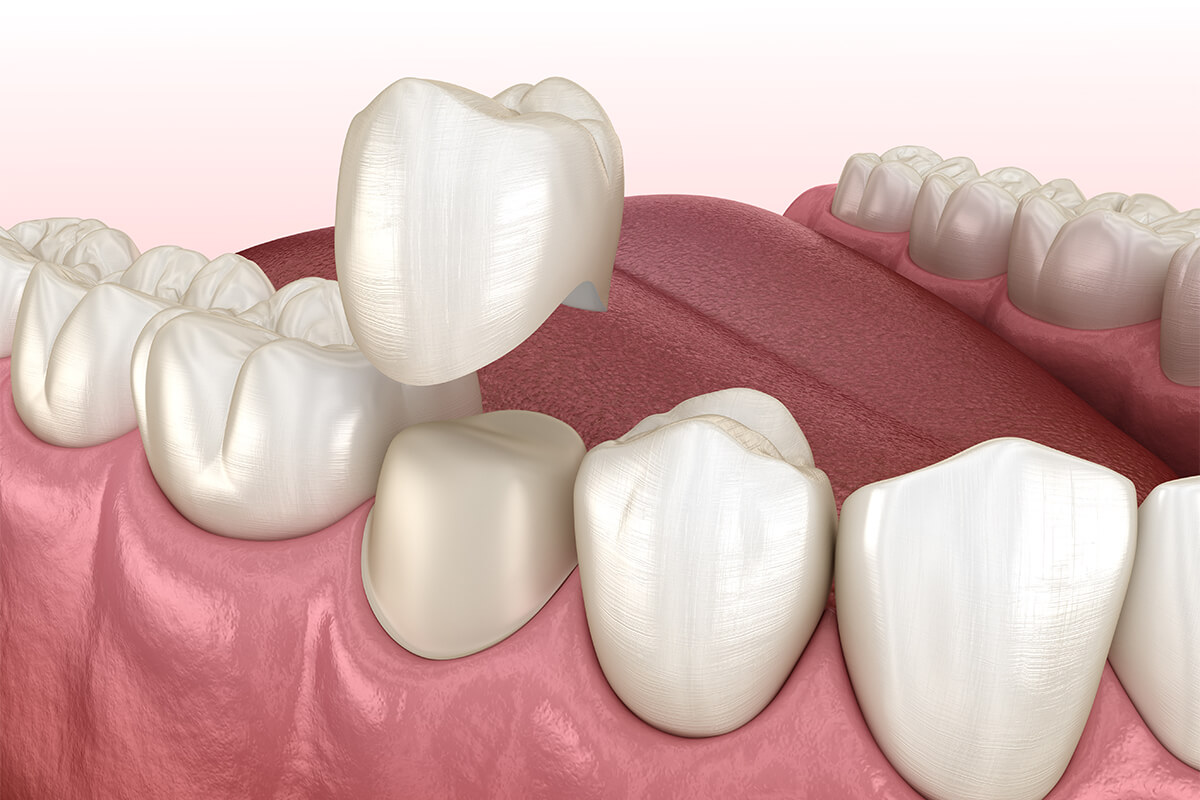 Dental Crowns Service in Newport Beach CA Area