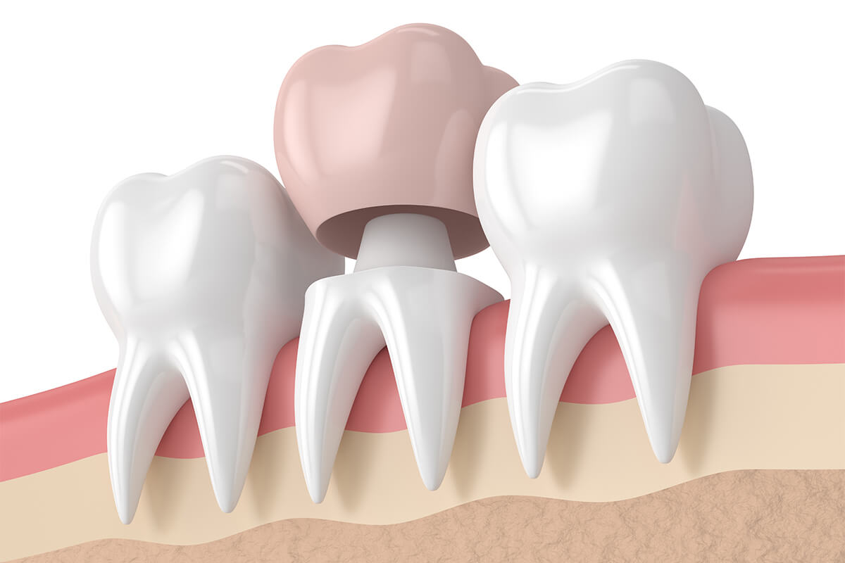 Dental Crown Procedure in Newport Beach CA Area