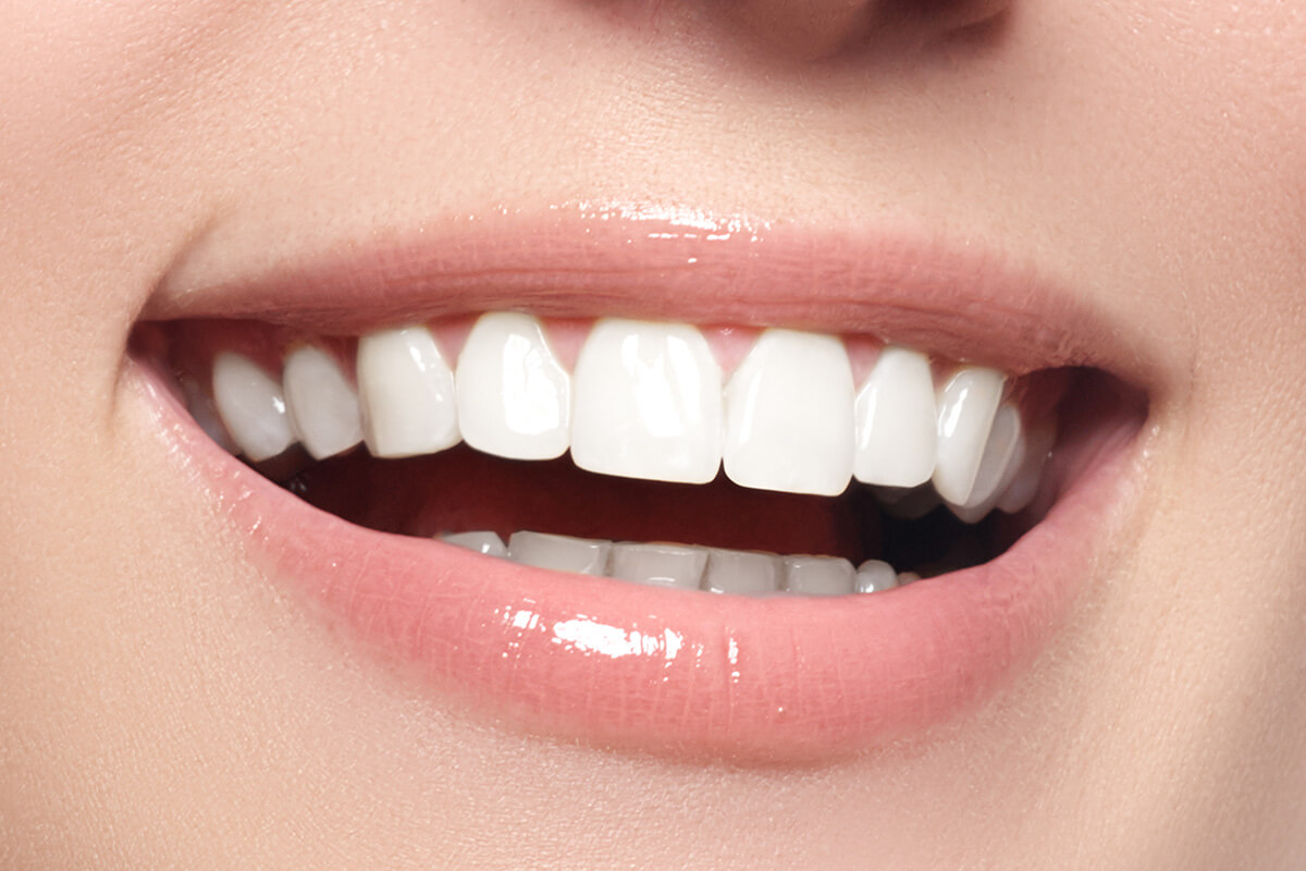 Natural Looking Veneers in Newport Beach Area