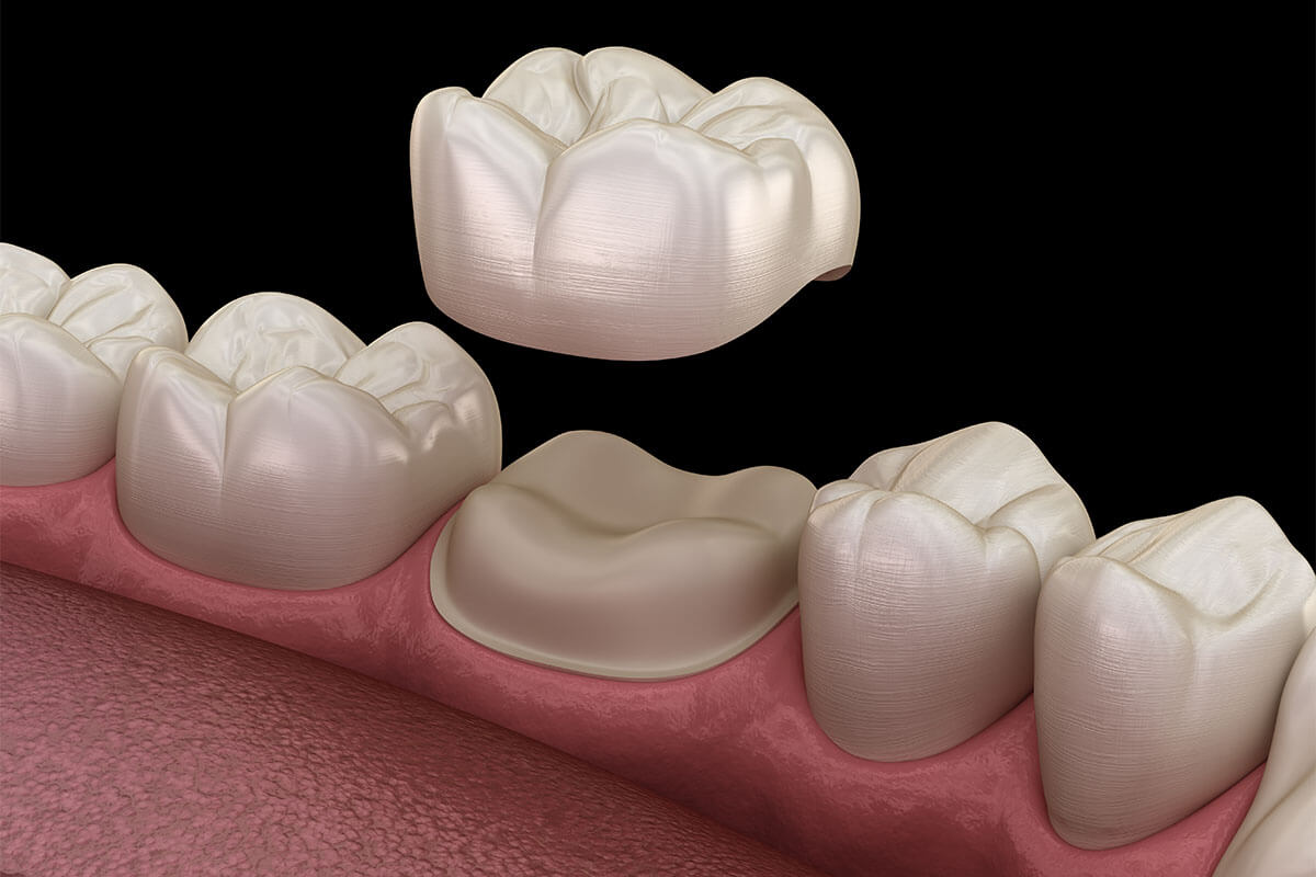 Crowns for Teeth in Newport Beach CA Area