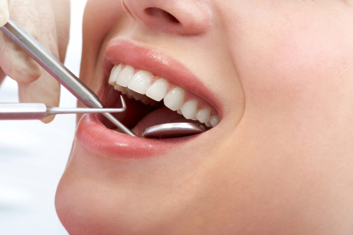Professional Teeth Cleaning in Newport Beach area